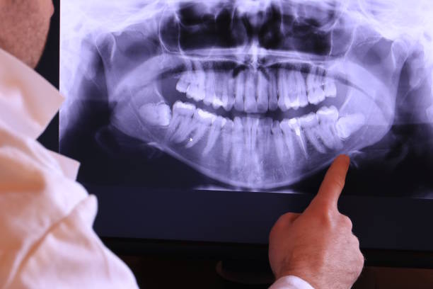 Best Emergency Wisdom Tooth Extraction in Millersville, TN